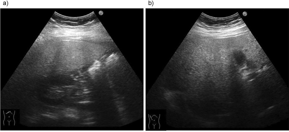 Hormone replacement therapy for steatotic liver management after surgical menopause