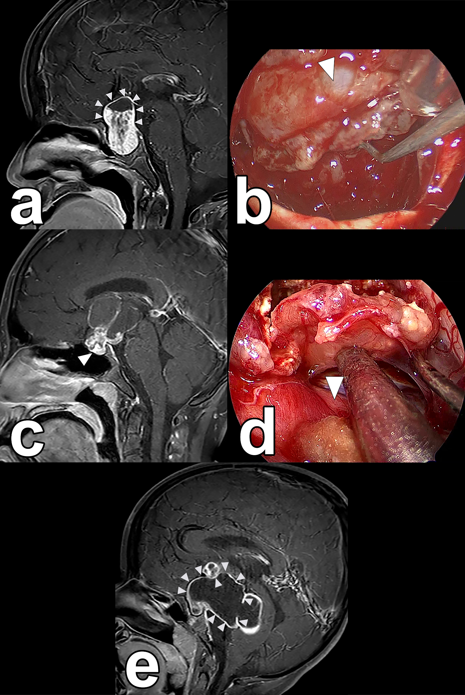 Outcomes of endoscopic endonasal surgery for pediatric craniopharyngioma with a focus on morphological preservation of the pituitary stalk and endocrine functions