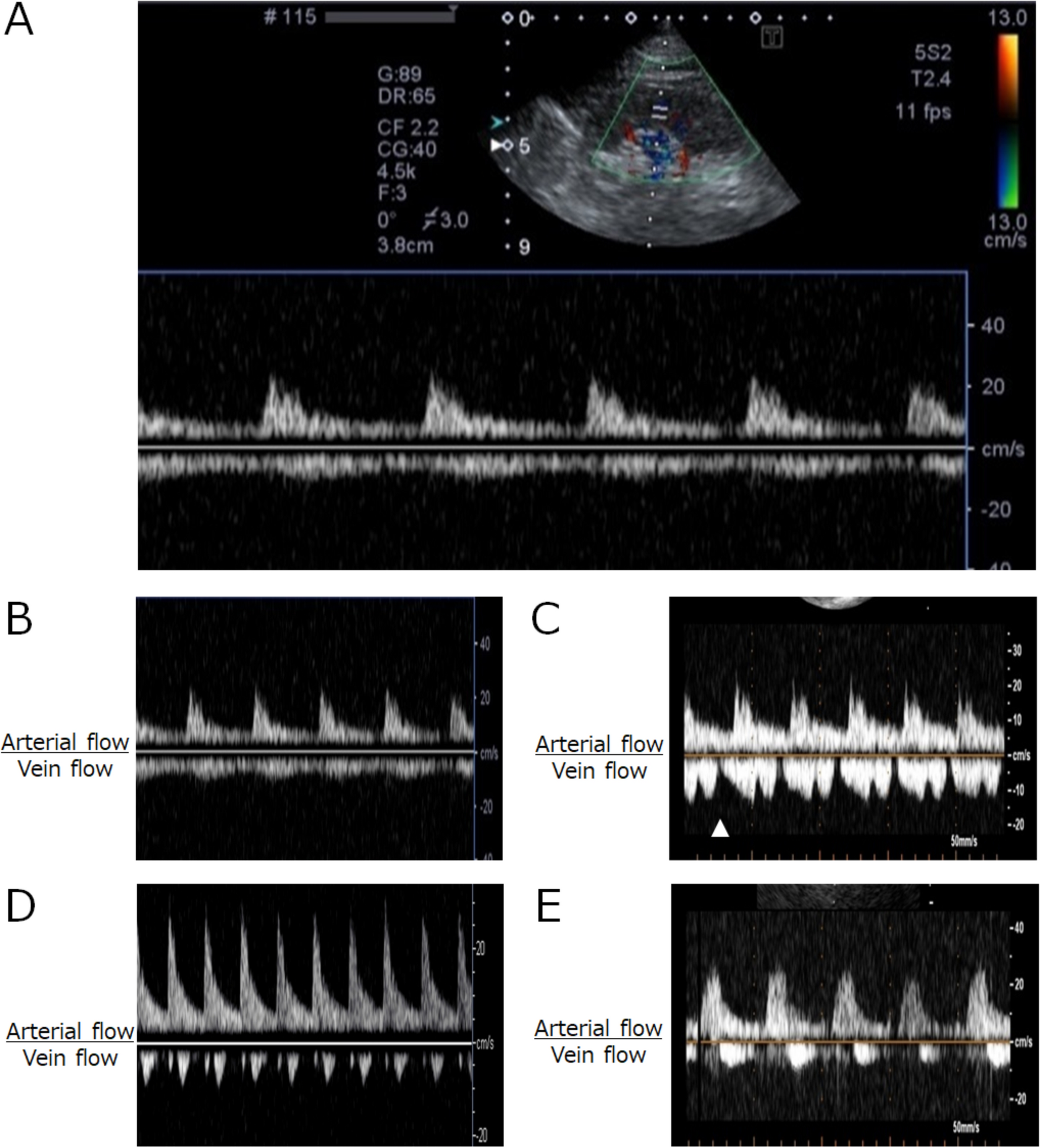 Evaluation of intrarenal vein flow patterns during routine echocardiography