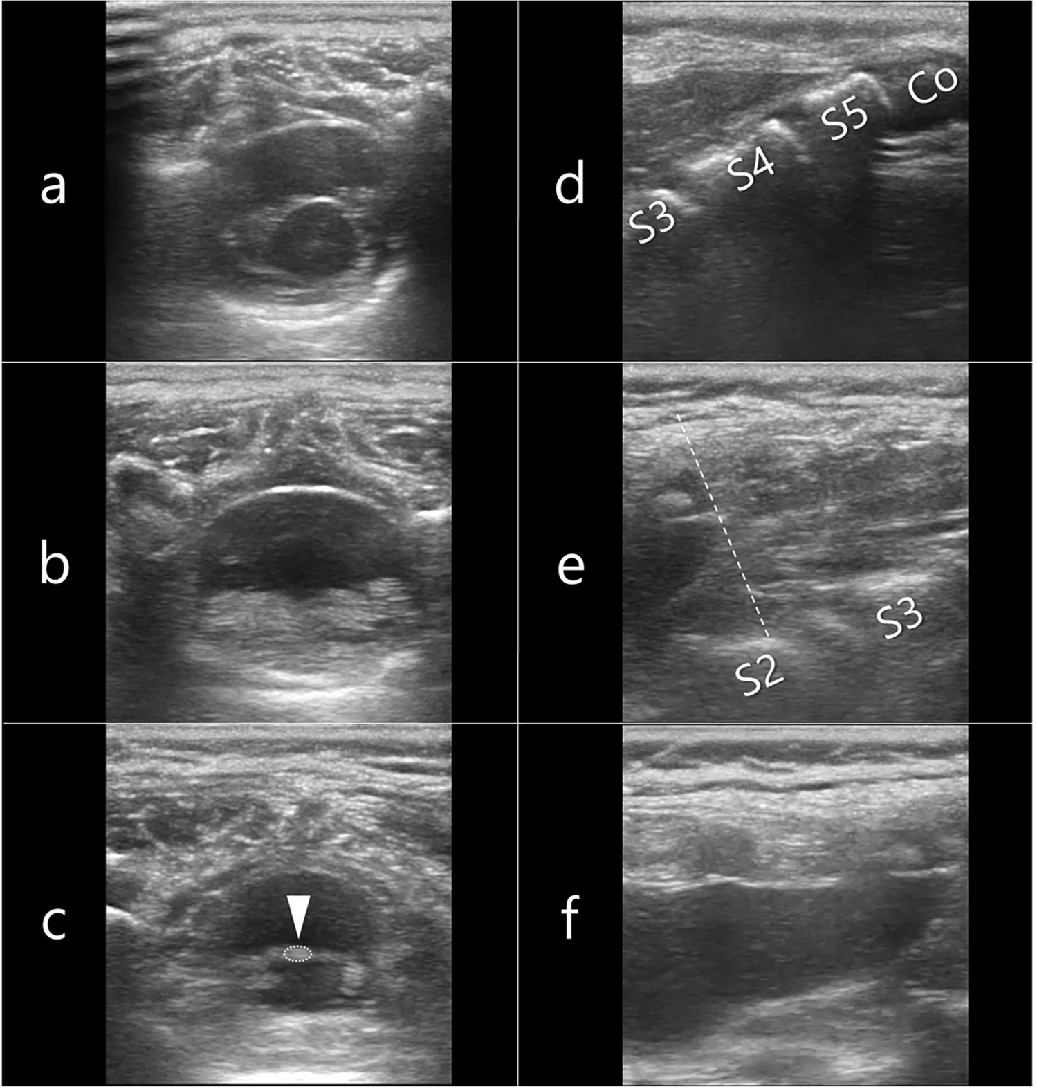 Efficacy of spinal ultrasonography just before caudal epidural block for identifying tethered cord syndrome in urological cases with sacral dimples: a retrospective descriptive study