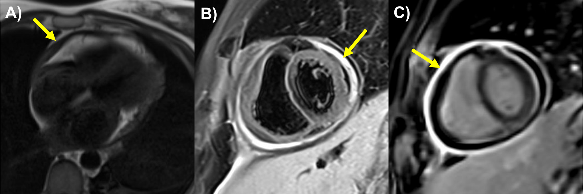 The Role of the Advanced Practice Provider in a Pericardial Center of Excellence