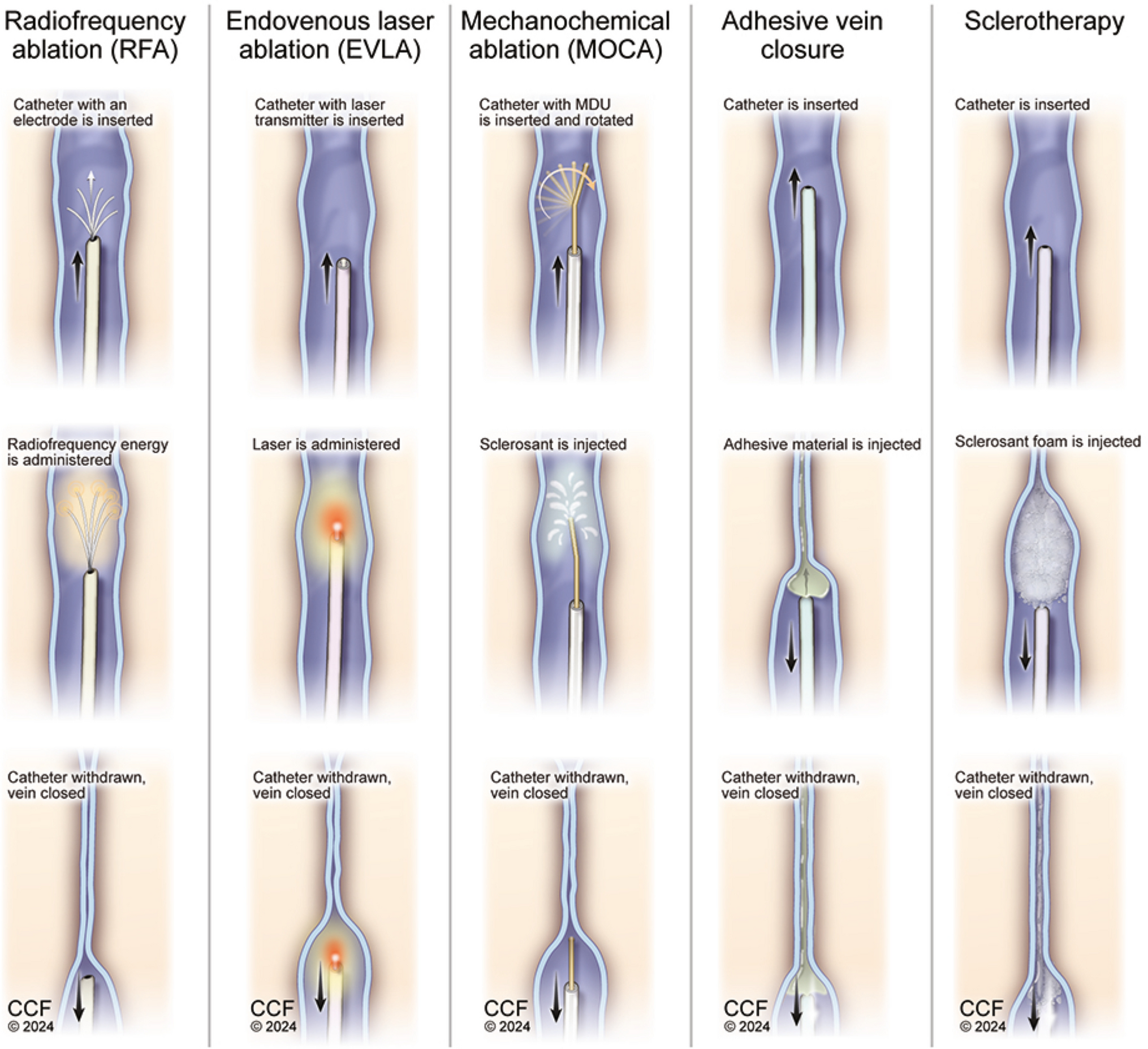 Venous Insufficiency: Endovascular and Surgical Treatment