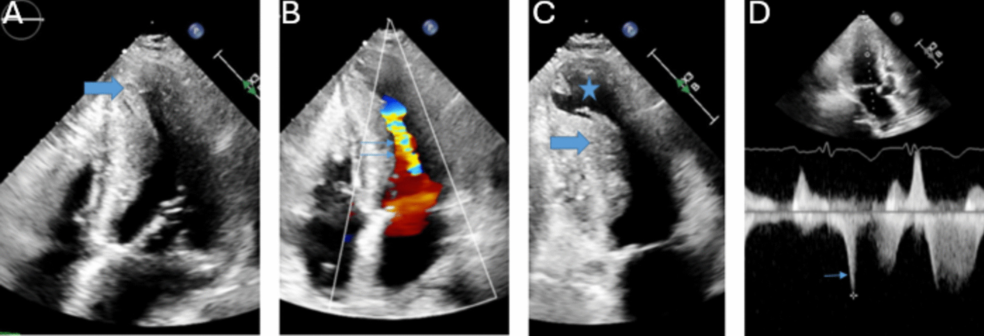 Echocardiography and Heart Failure: An Echocardiographic Decision Aid for the Diagnosis and Management of Cardiomyopathies