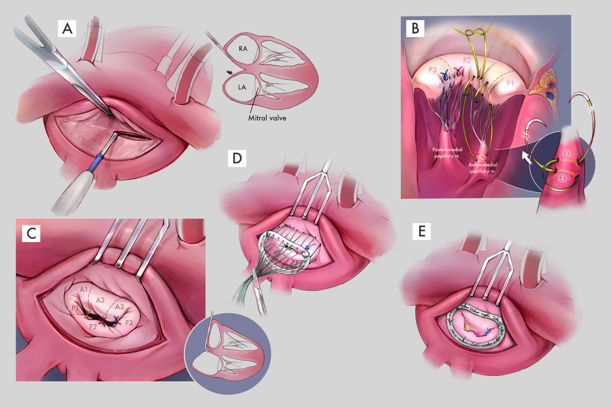 Surgical Techniques for Mitral Valve Repair: A Review for the Non-Cardiac Surgeon