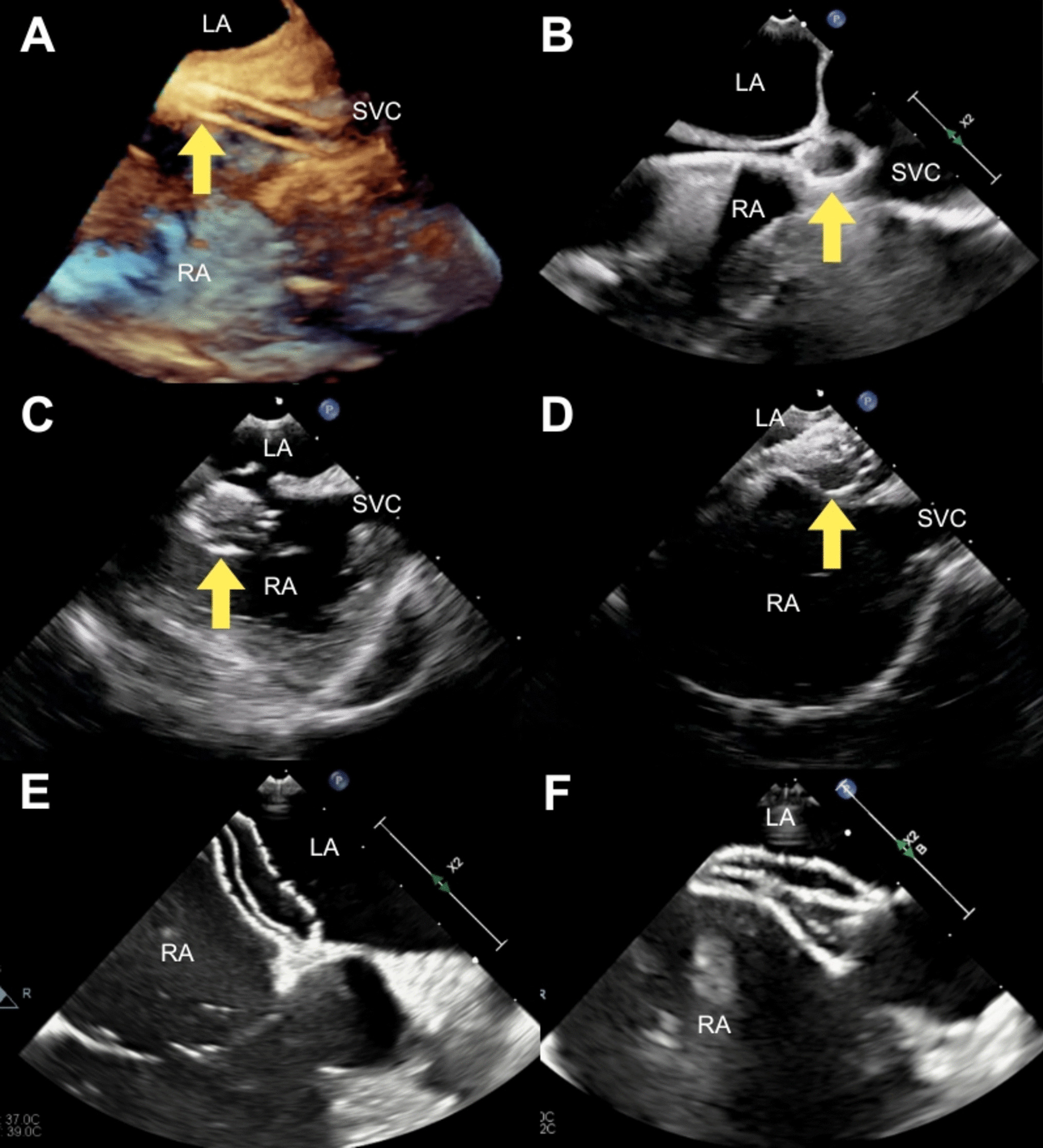 Fluoroscopy-free Transcatheter Atrial Septal Defect Closure: A Simplified Approach