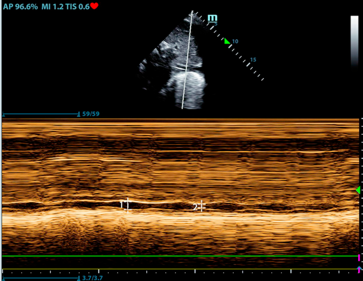 Point-of-Care Ultrasonography in the Critical Care Unit: An Update