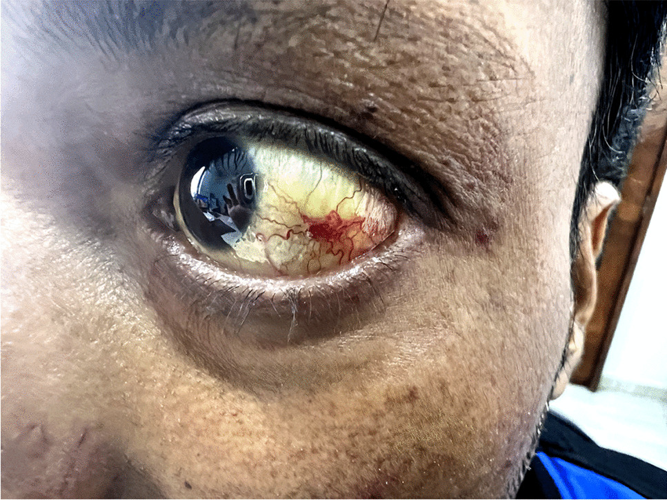 Spider telangiectasia in conjuctiva
