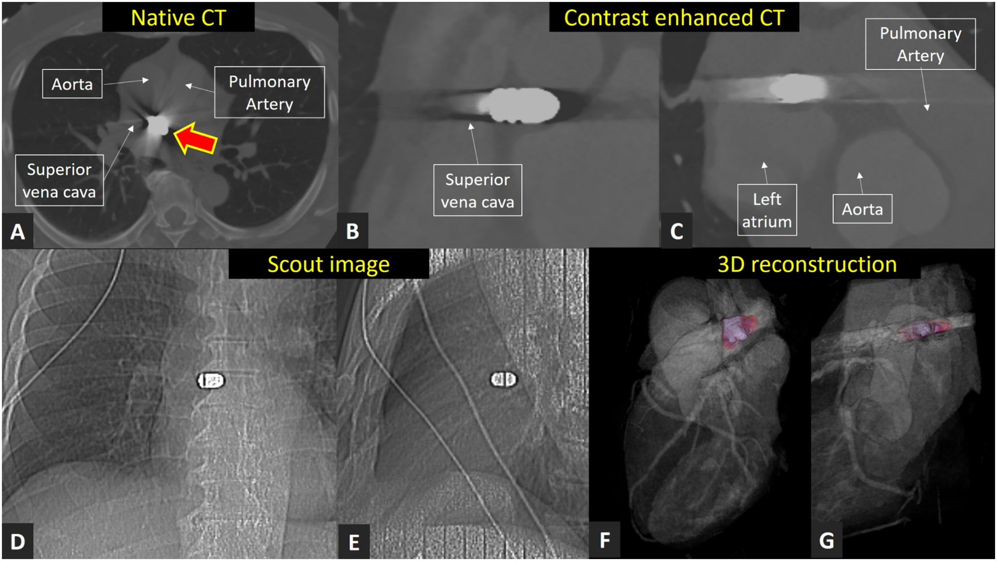 The forgotten bullet: a rare coronary-CT image discovery