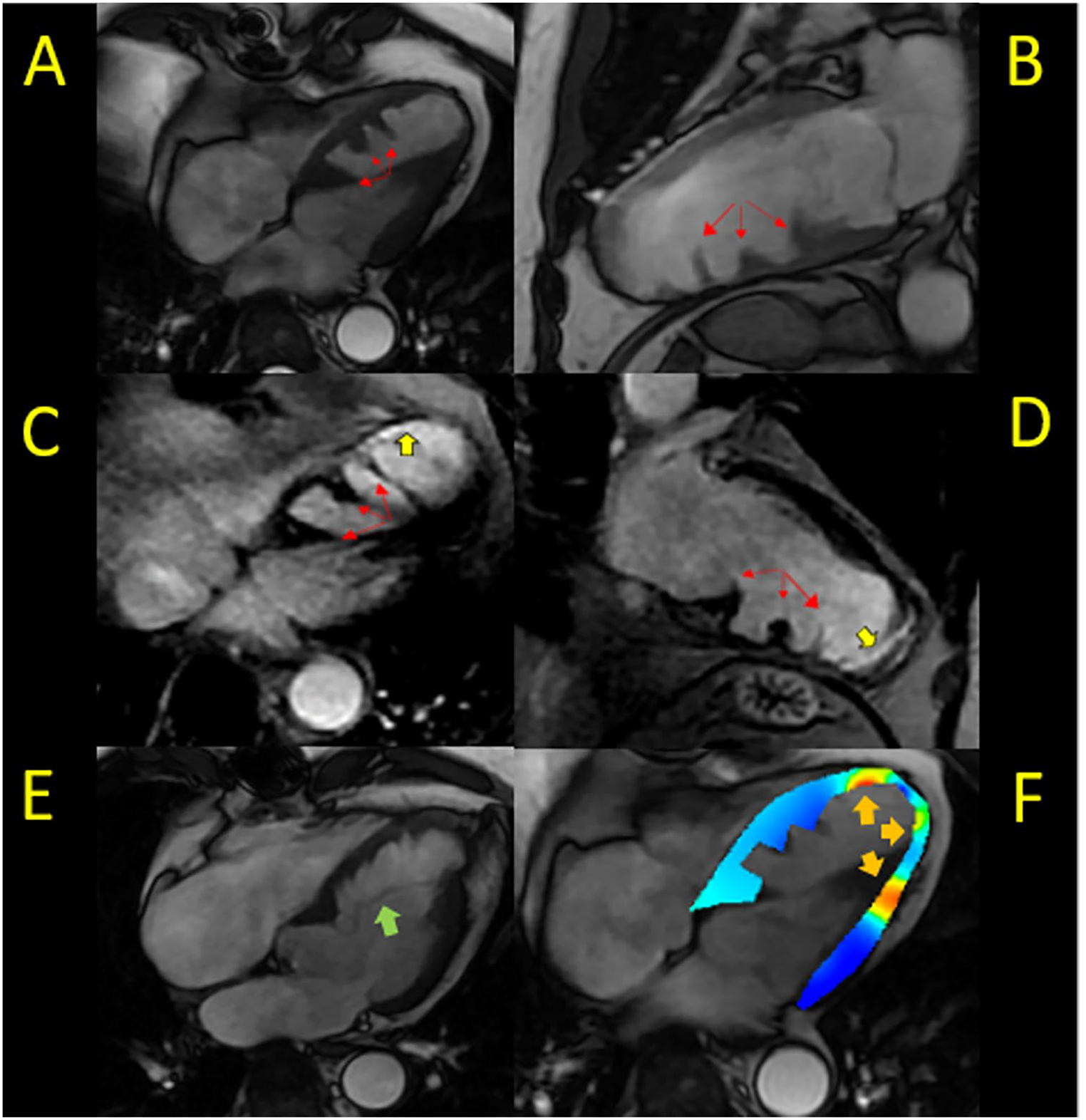 Saw-tooth myocardium: An uncommon but characteristic left ventricular dysplasia