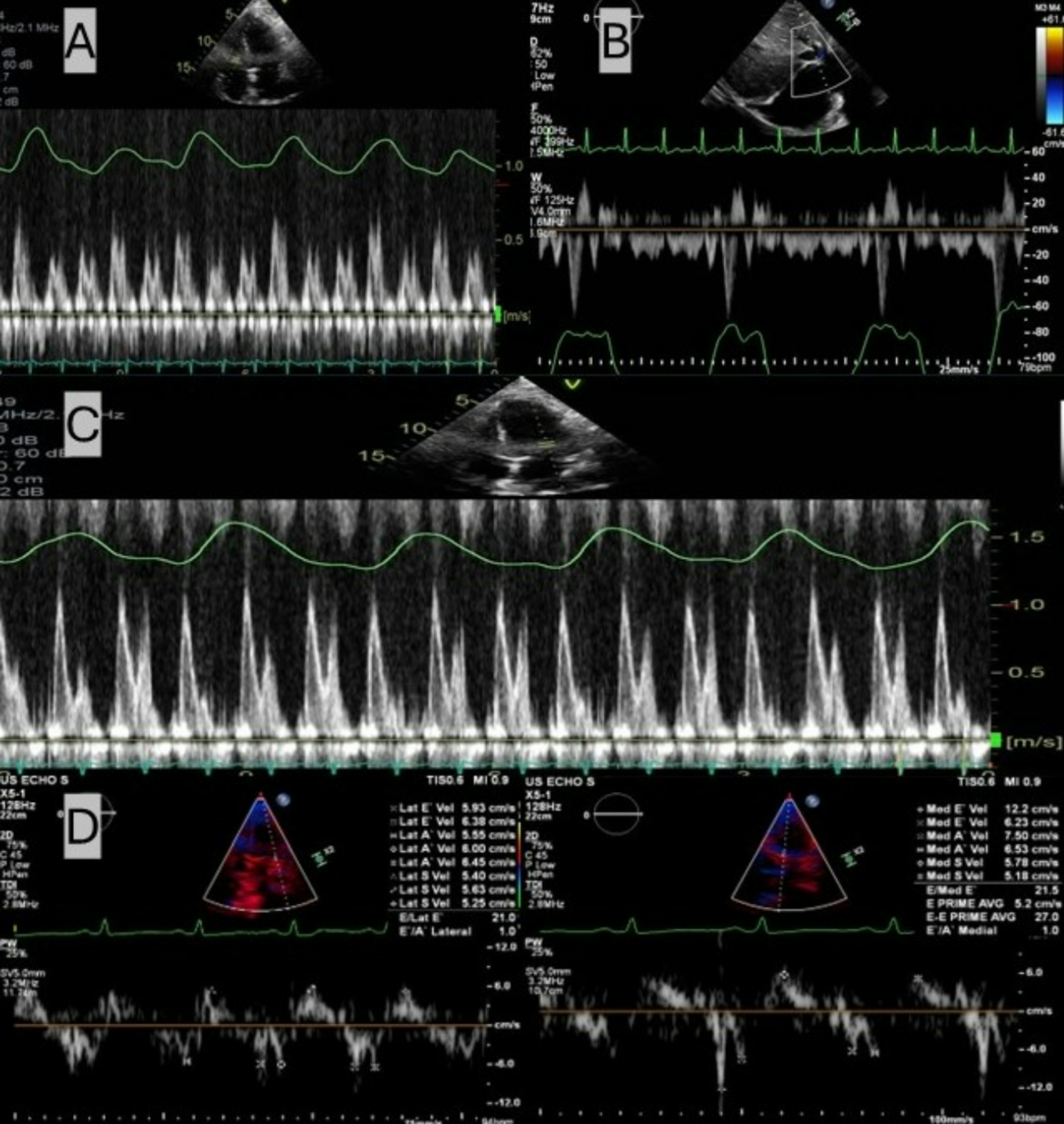 A case of constrictive pericarditis with aortic insufficiency: the role of cardiac magnetic resonance imaging