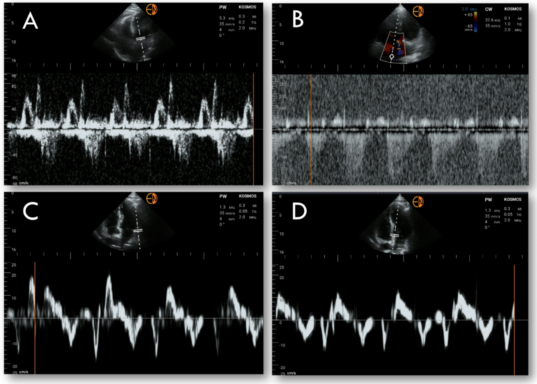 Reliability of spectral Doppler in handheld ultrasonographic device