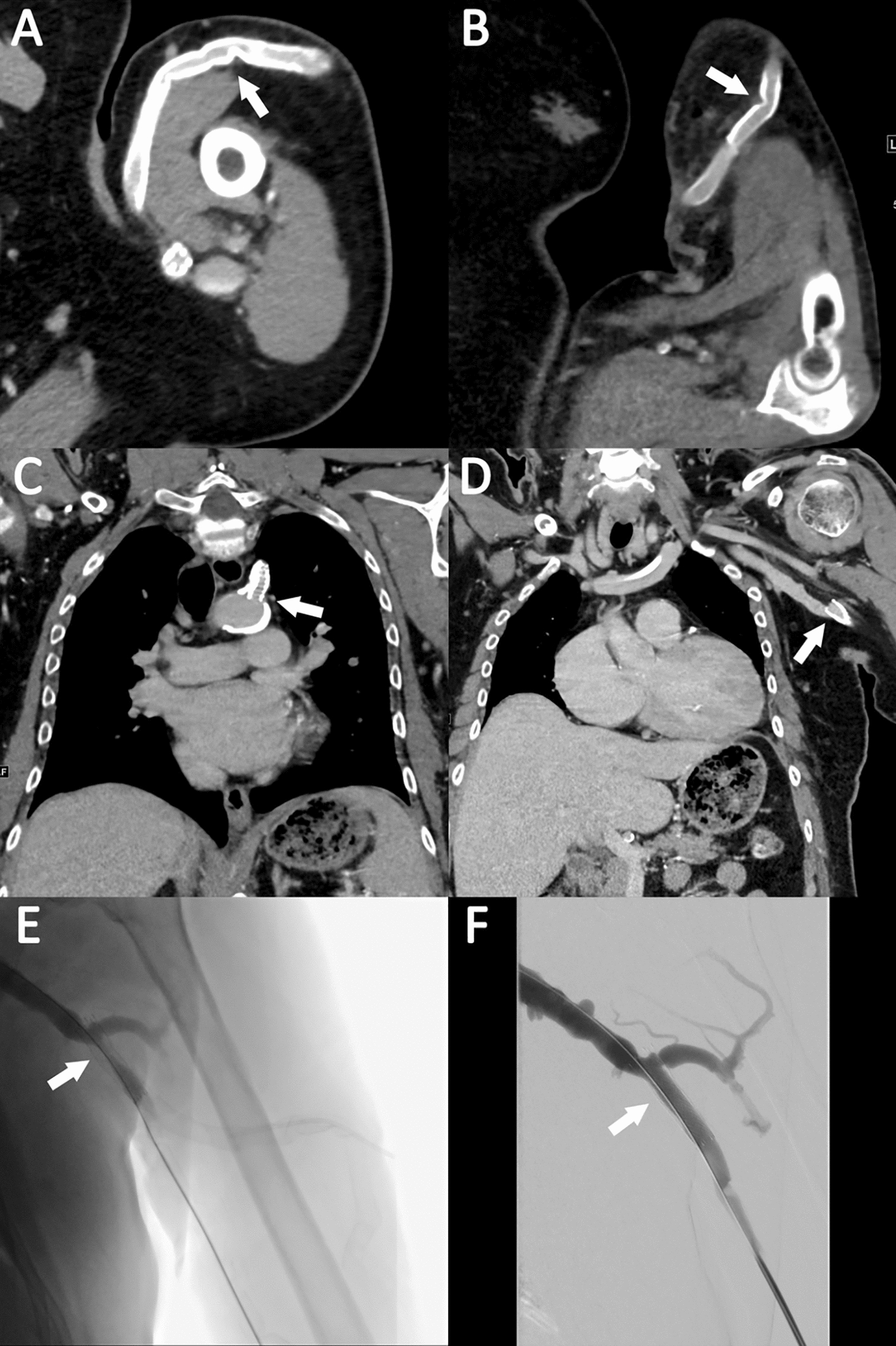 Cross-sectional imaging for presurgical planning of dialysis circuit vascular access creation in the end stage renal disease patient population