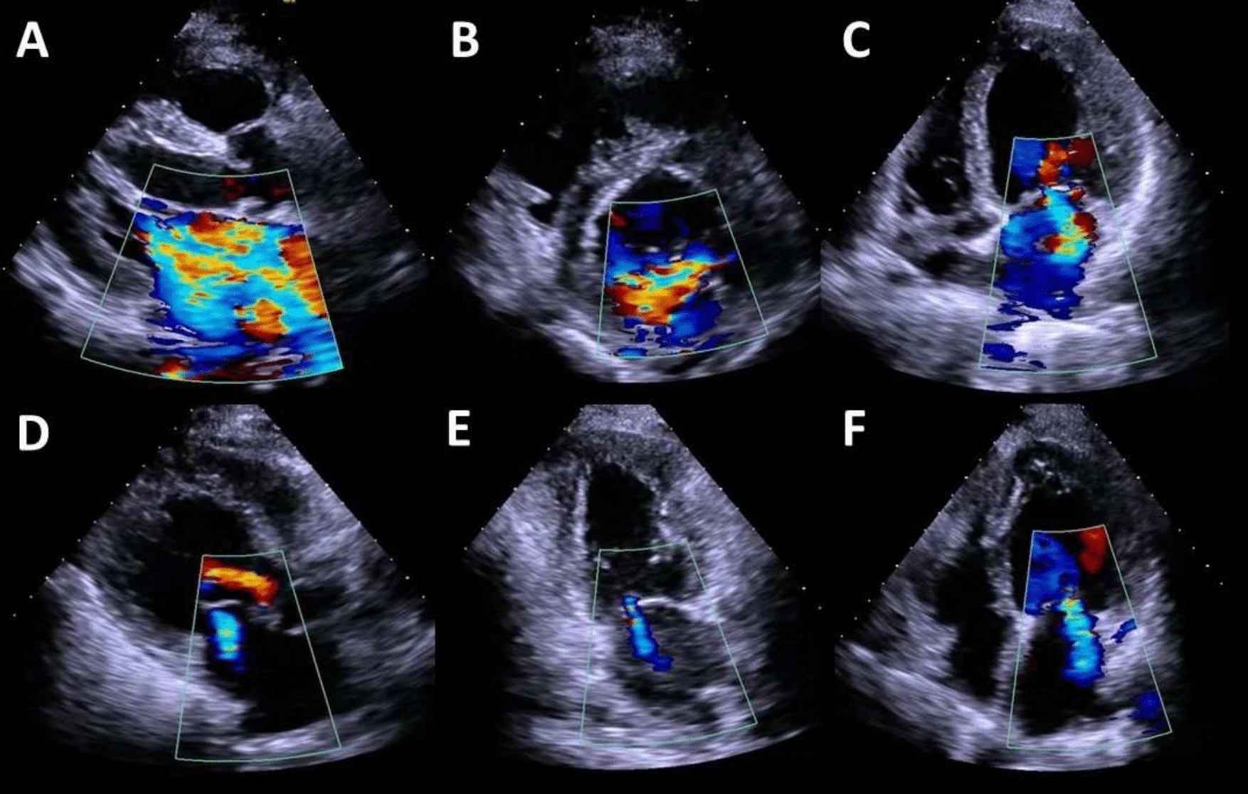 Positional mitral regurgitation: a dynamic phenomenon