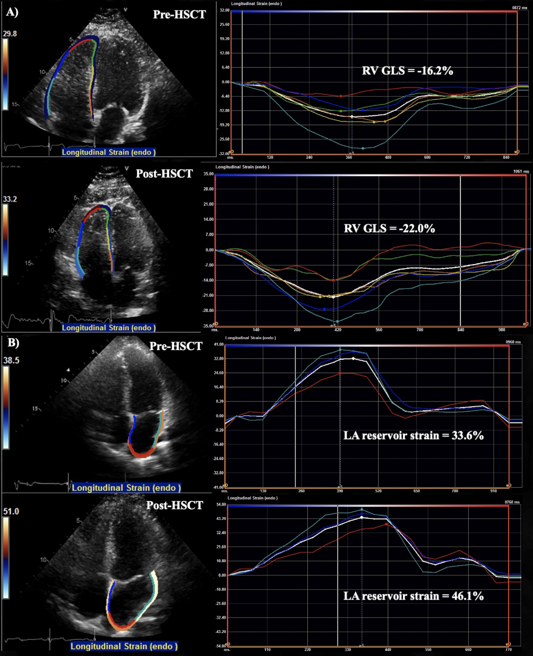 The effect of hematopoietic stem cell transplantation on cardiac mechanics in systemic sclerosis