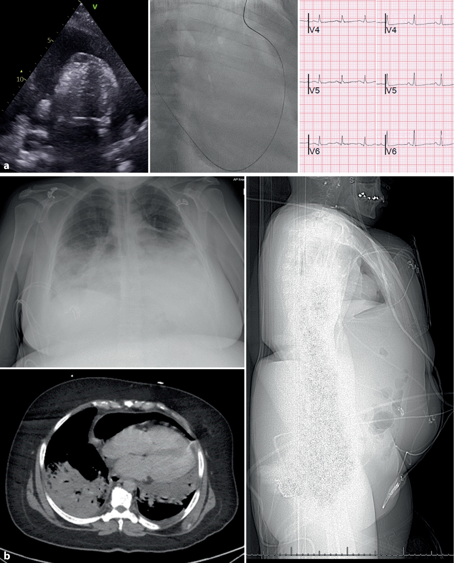 Noonan syndrome and parasternal pericardiocentesis