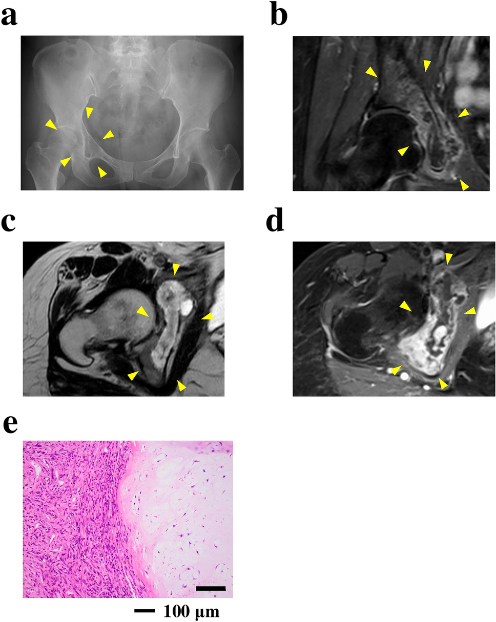 Establishment and characterization of NCC-dCS2-C1: a novel patient-derived cell line of dedifferentiated chondrosarcoma