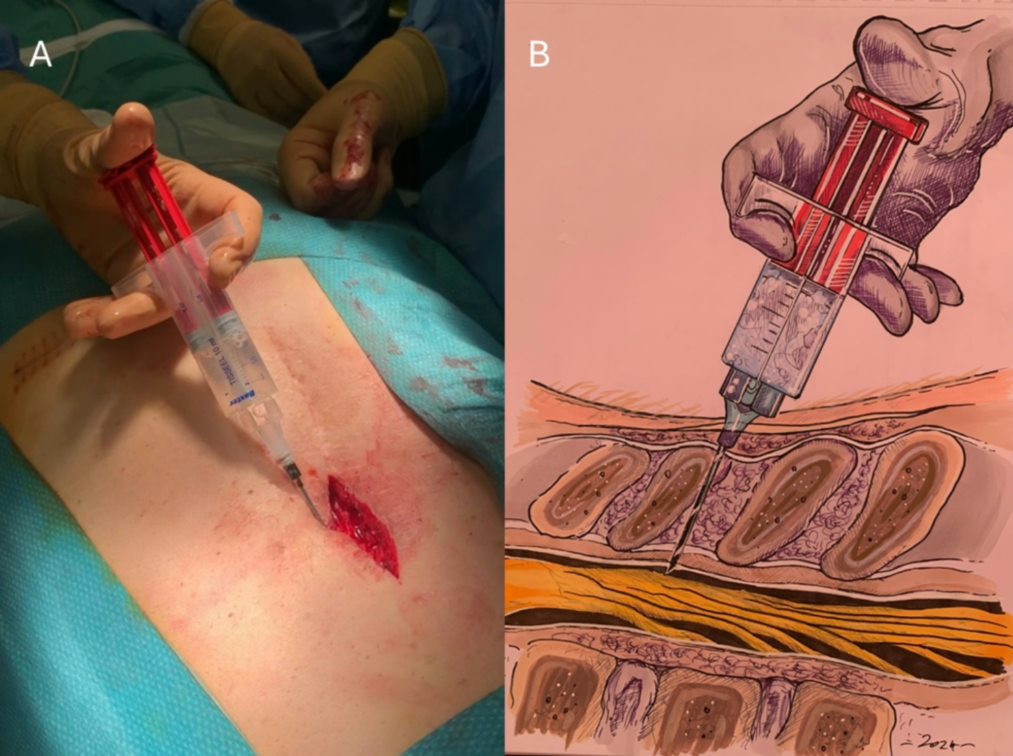Prophylactic Fibrin Glue Application for Immediate Management of Dural Puncture during Spinal Cord Stimulation Lead Placement: a Simple and Effective Technique