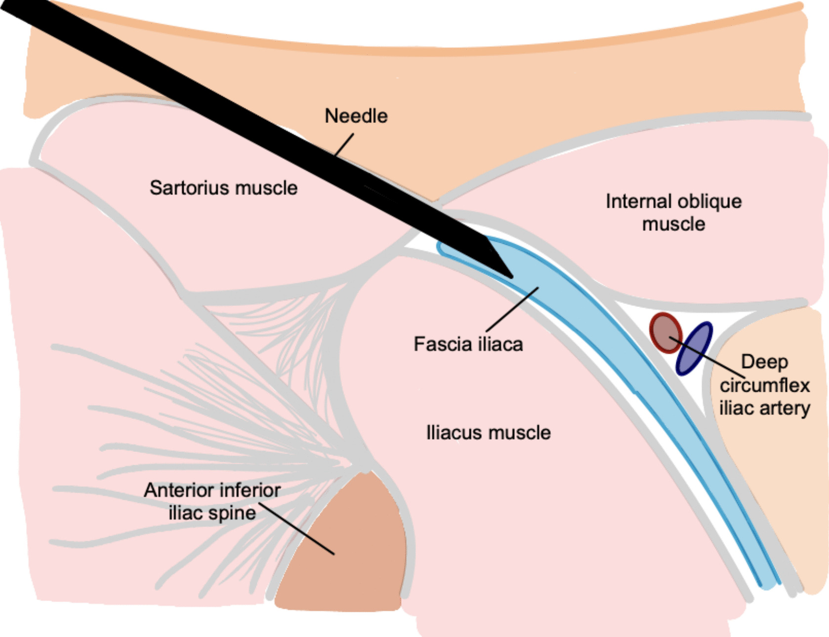 Efficacy of Suprainguinal Fascia Iliaca Block for Pain Management in Hip Surgeries: A Narrative Review