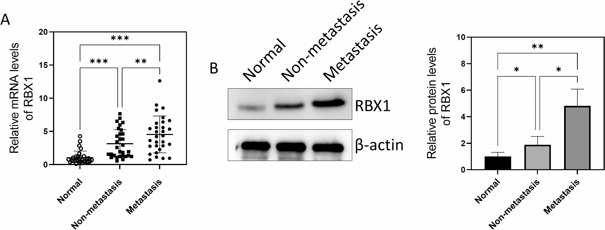 RING box protein-1 promotes the metastasis of cervical cancer through regulating matrix metalloproteinases via PI3K/AKT signaling pathway