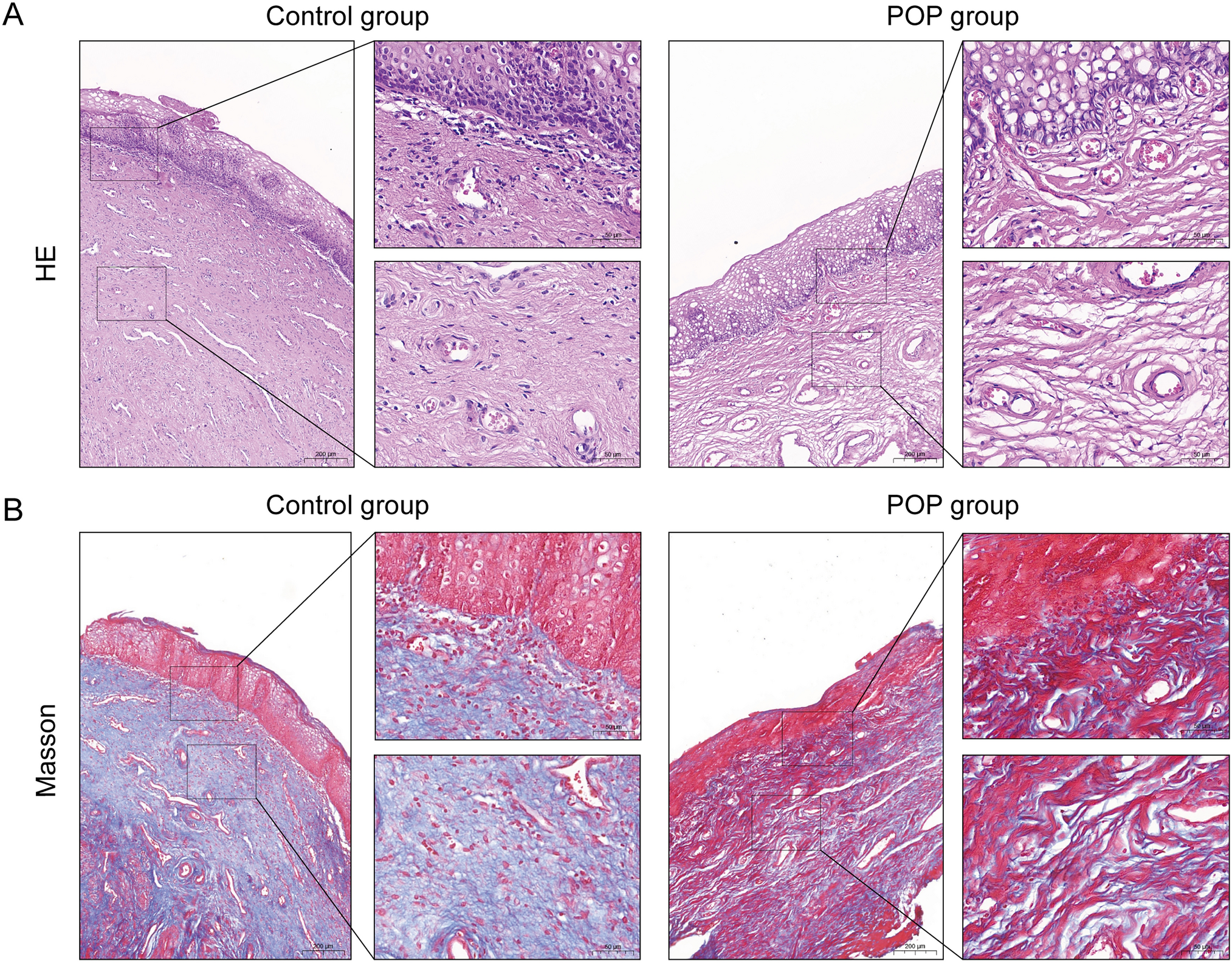 Ciliary neurotrophic factor (CNTF) contributes to pelvic organ prolapse by modulating collagen expression via the JAK2–STAT3 pathway