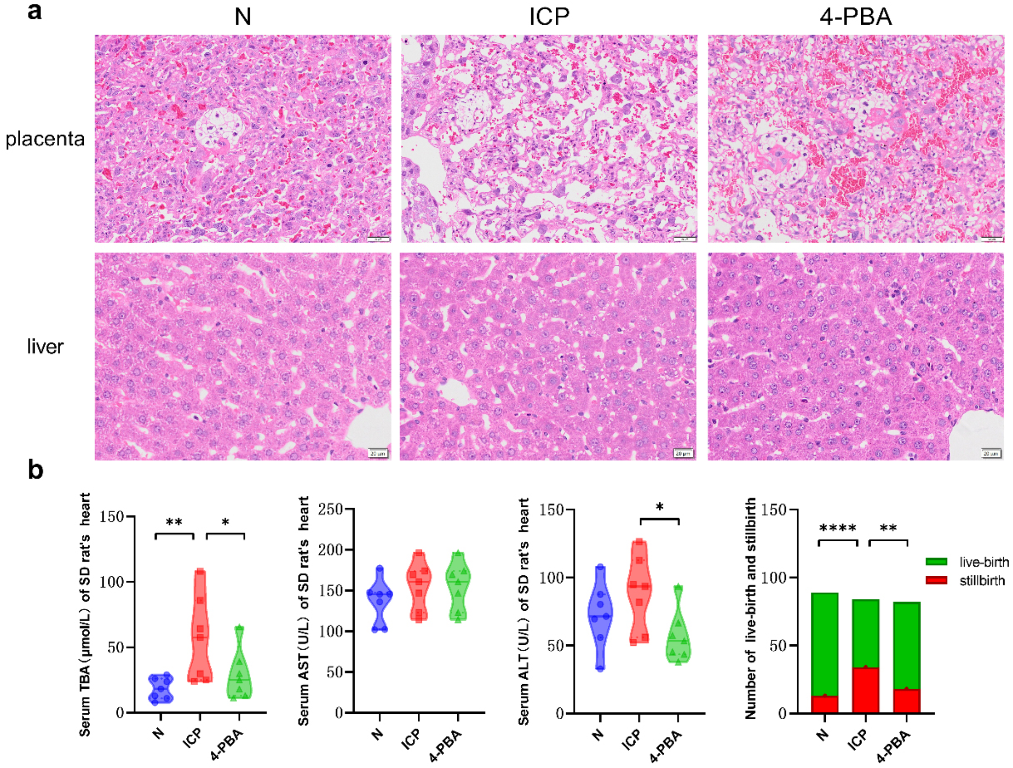 Efficacy and mechanism of inhibition of the GPR30-PI3K pathway by 4-phenylbutyric acid in the treatment of intrahepatic cholestasis of pregnancy