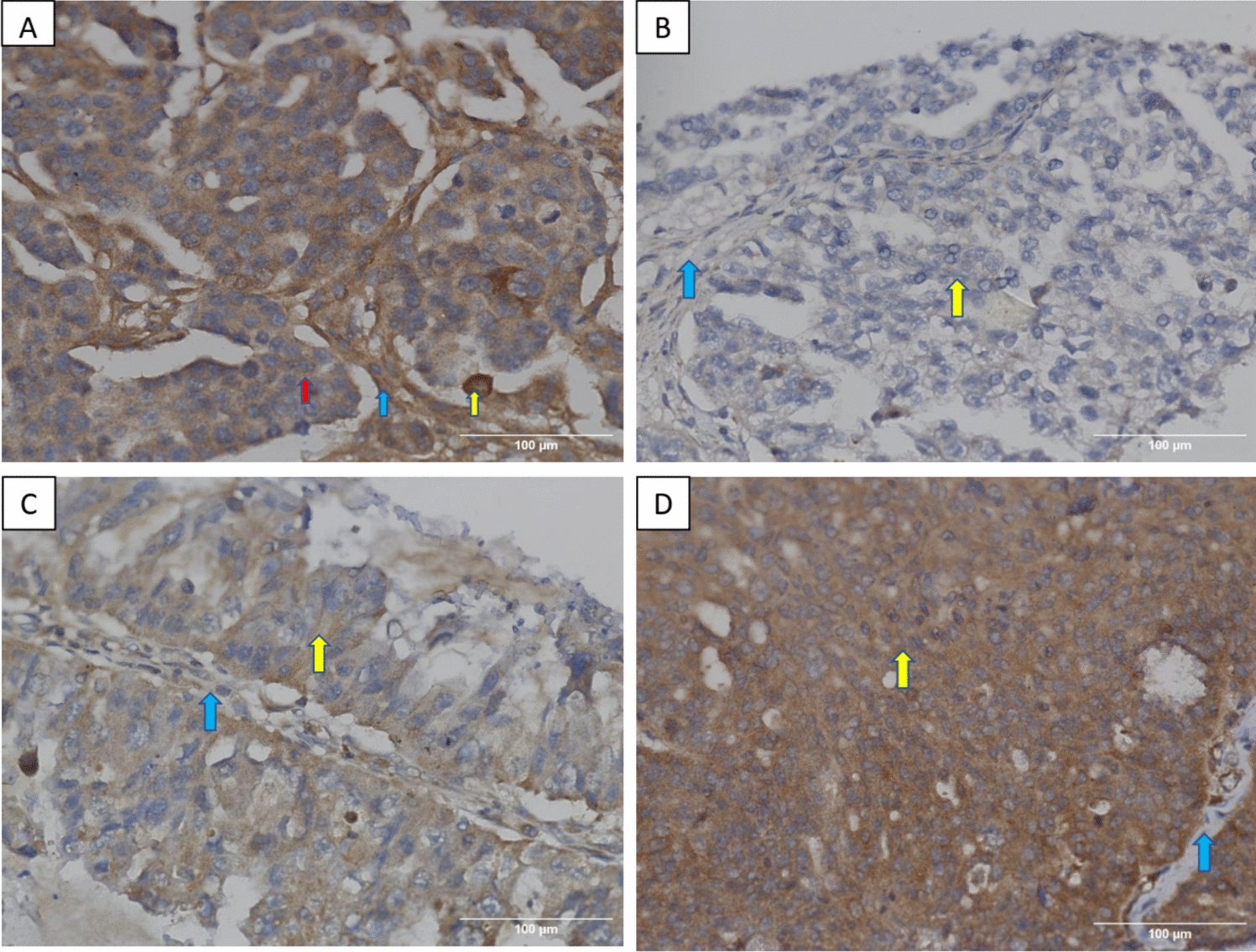 Clinicopathological Profiles and Proliferative Activity of GnRH Receptor Type II Expressing Ovarian Cancer