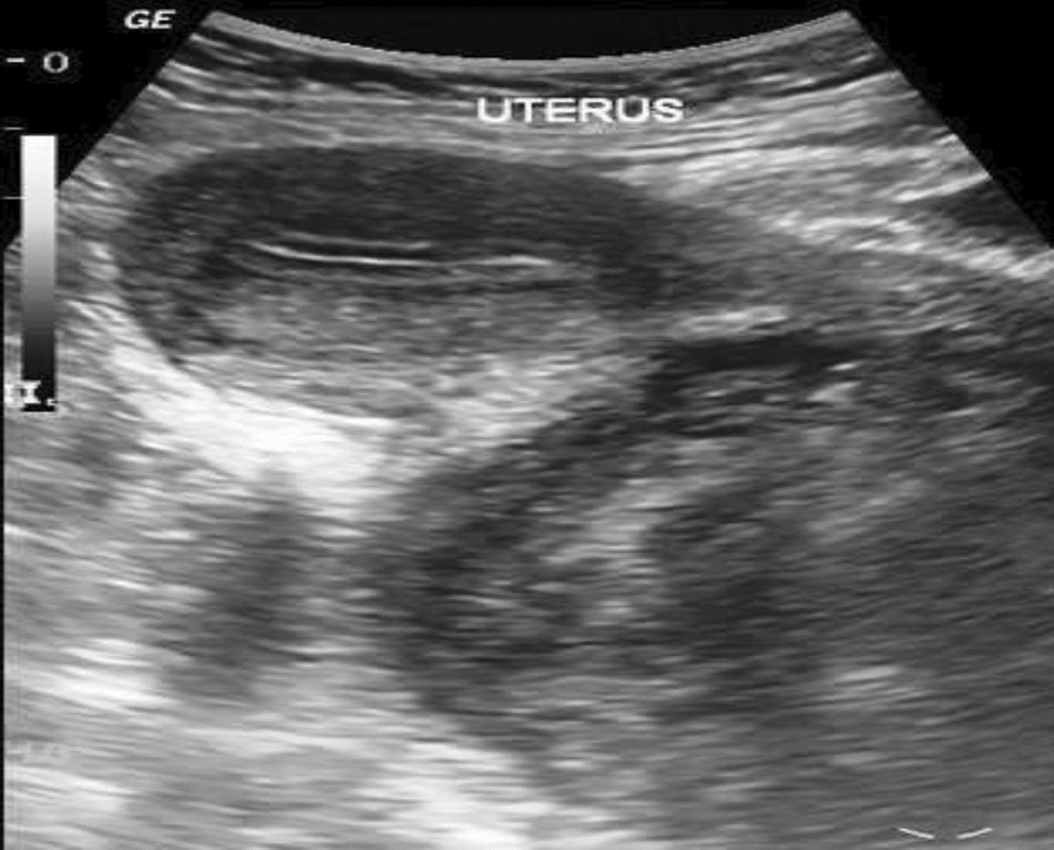 “STUMPing” the Gynecologist: Our Experience