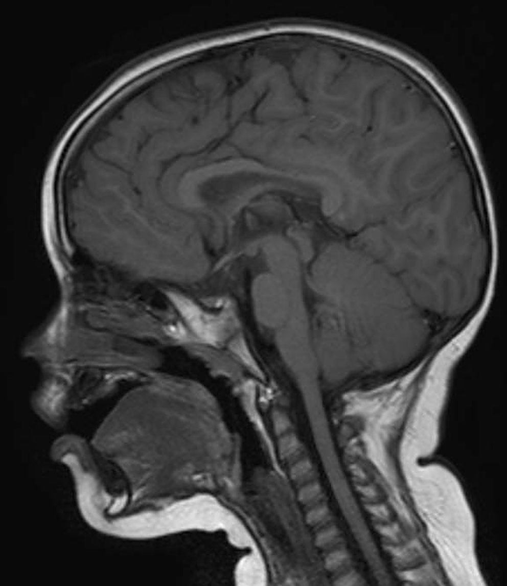 Axonal motor polyneuropathy in a 13 years old Girl with a  variant in