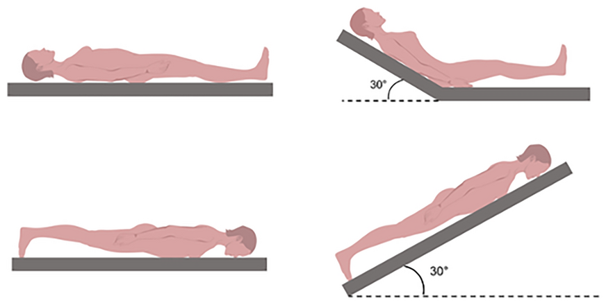 Effects of ‘Head Up’ Prone Position on Transcranial Color Doppler–Based Estimators of Intracranial Pressure in Moderate to Severe Acute Respiratory Distress Syndrome Without Brain Injury: A Cross-Over, Longitudinal, Physiological Study