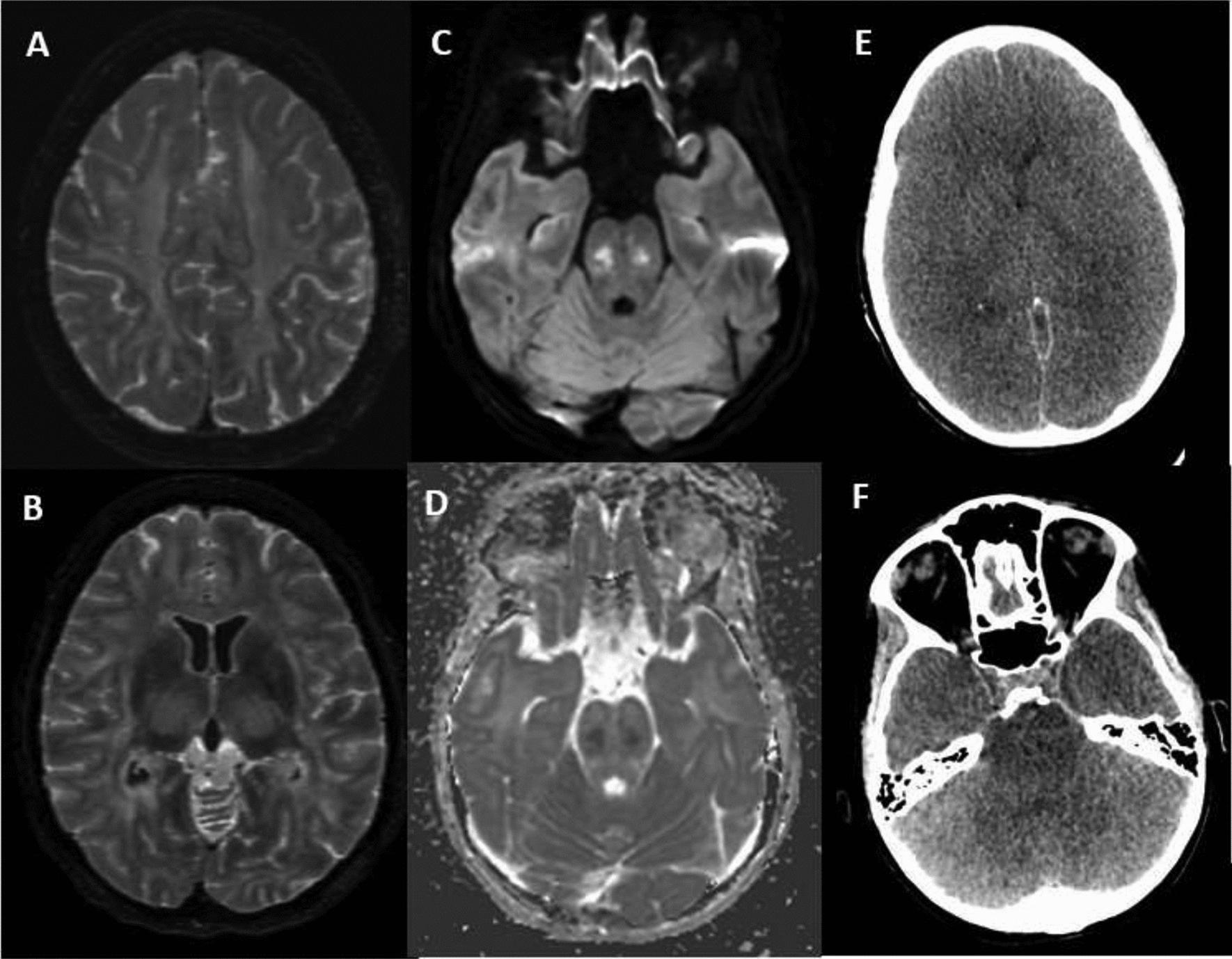Fatal Grade V Immune Effector Cell–Associated Neurotoxicity Syndrome After Chimeric Antigen Receptor T Cell Therapy Leading to Brain Death