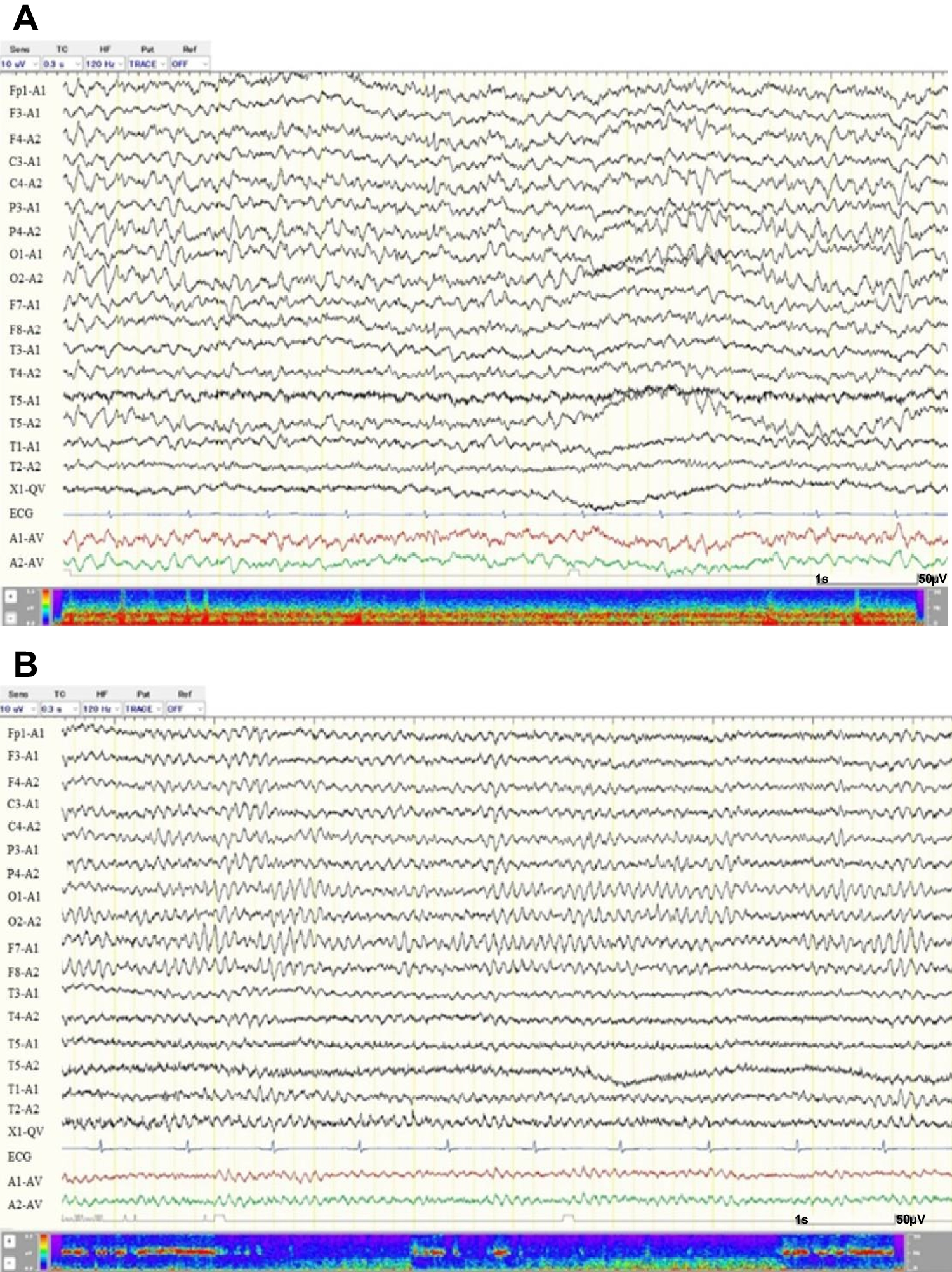 Severe perampanel intoxication presenting with rapidly progressive dementia