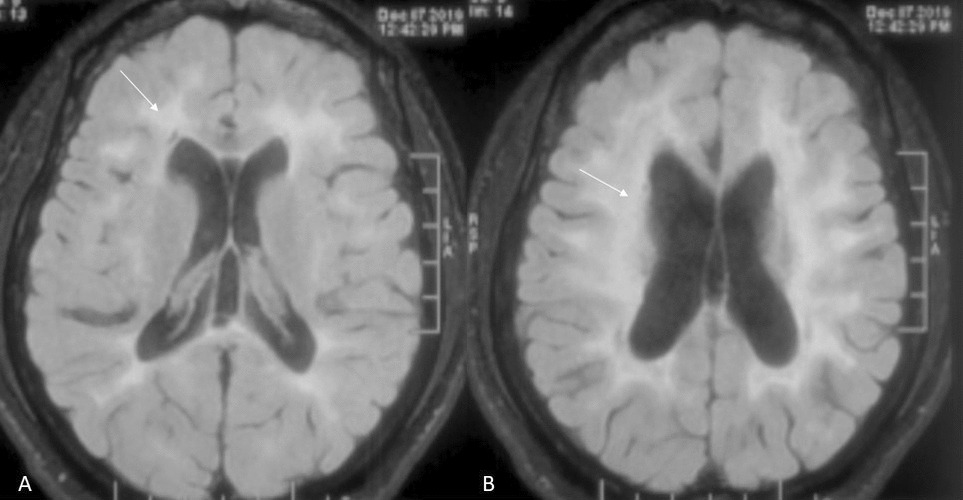 -related disorder: A clinical, imaging and genetic profile review