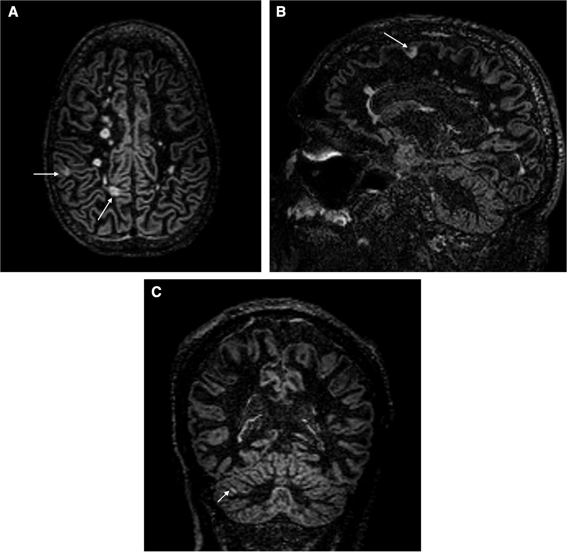 Presence of cortical lesions in older persons with multiple sclerosis and association with cognitive function