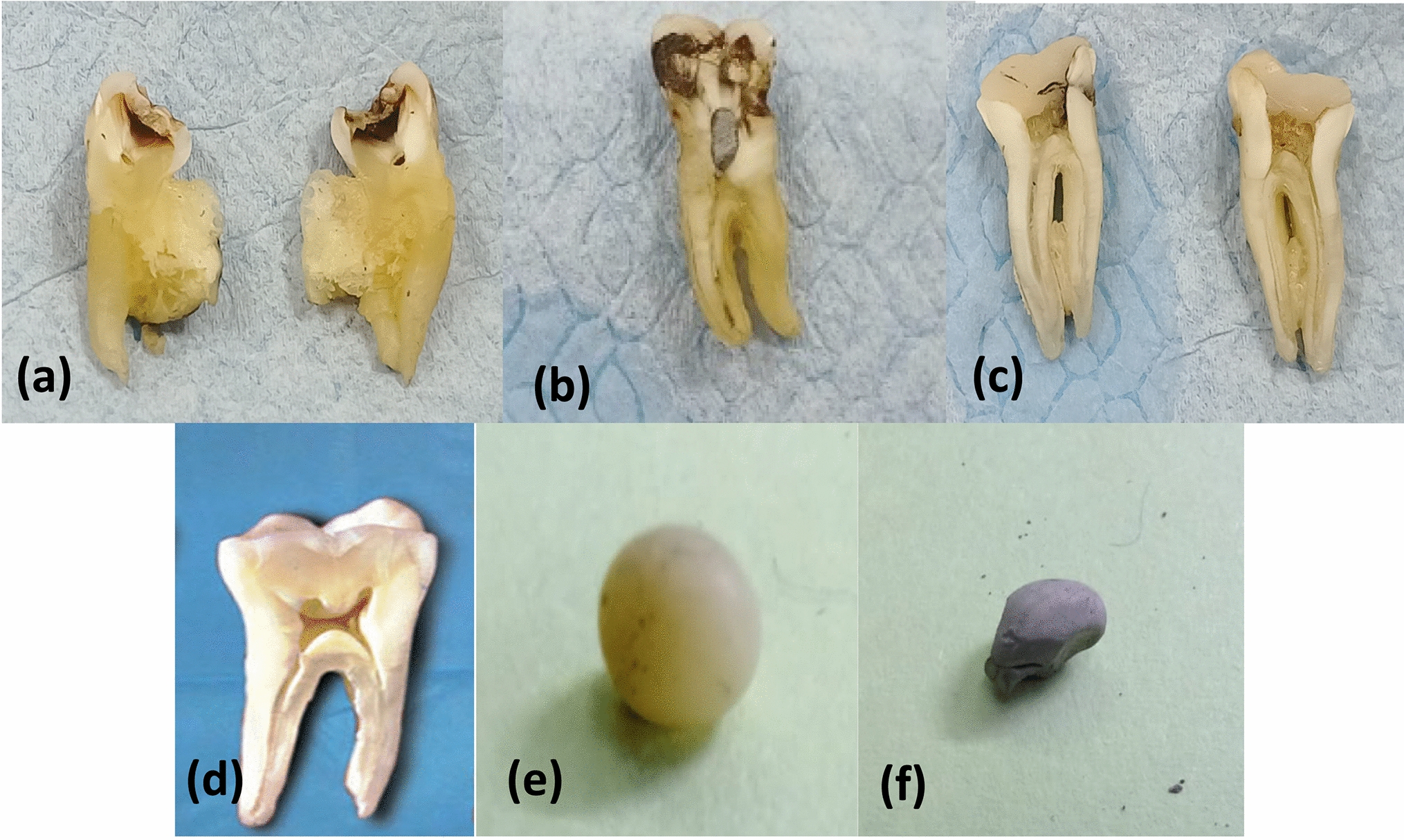Heavy metal migration from dental filling materials to calcified oral tissues: an in vitro analysis using LIBS and ICP-MS techniques