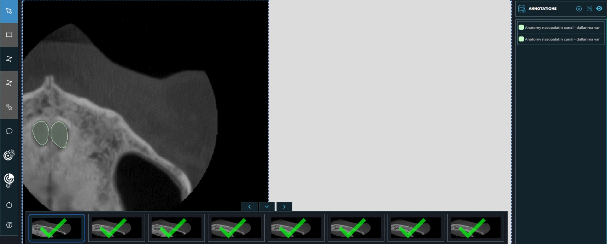 Segmentation of the nasopalatine canal and detection of canal furcation status with artificial intelligence on cone-beam computed tomography images