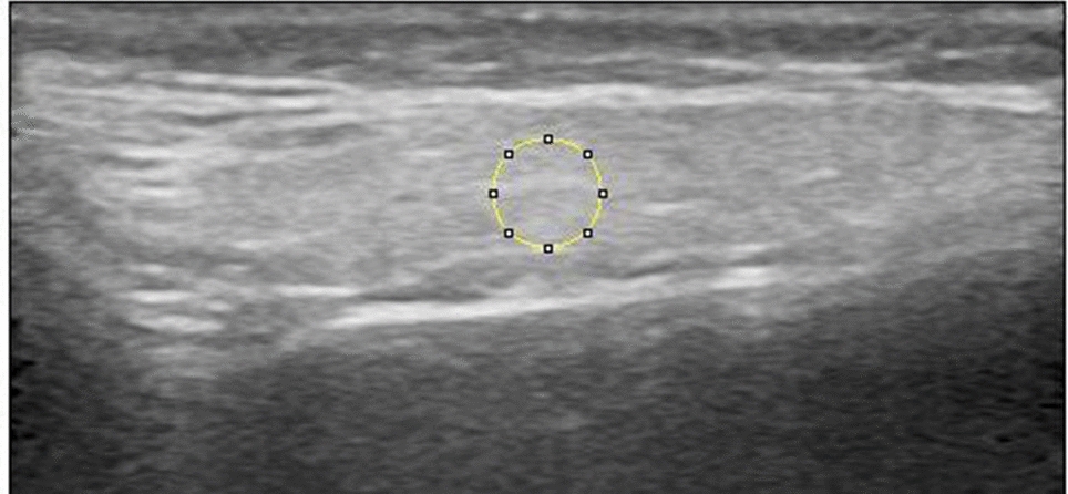 Comparison of stimulated and unstimulated salivary gland parenchyma using fractal analysis of ultrasonographic images