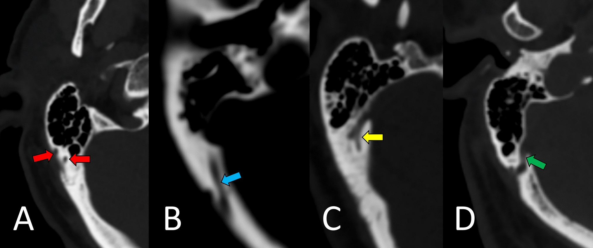 Assessment of mastoid emissary foramen morphology: a multidetector computed tomography study