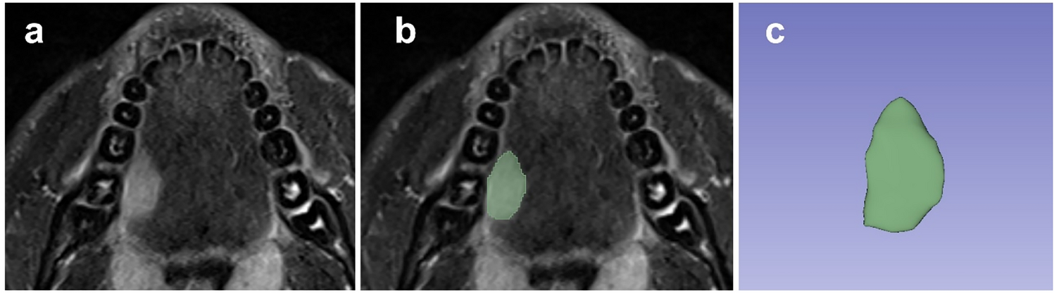 Can MRI radiomics predict neck metastasis at initial diagnosis in patients with squamous cell carcinoma of the tongue?