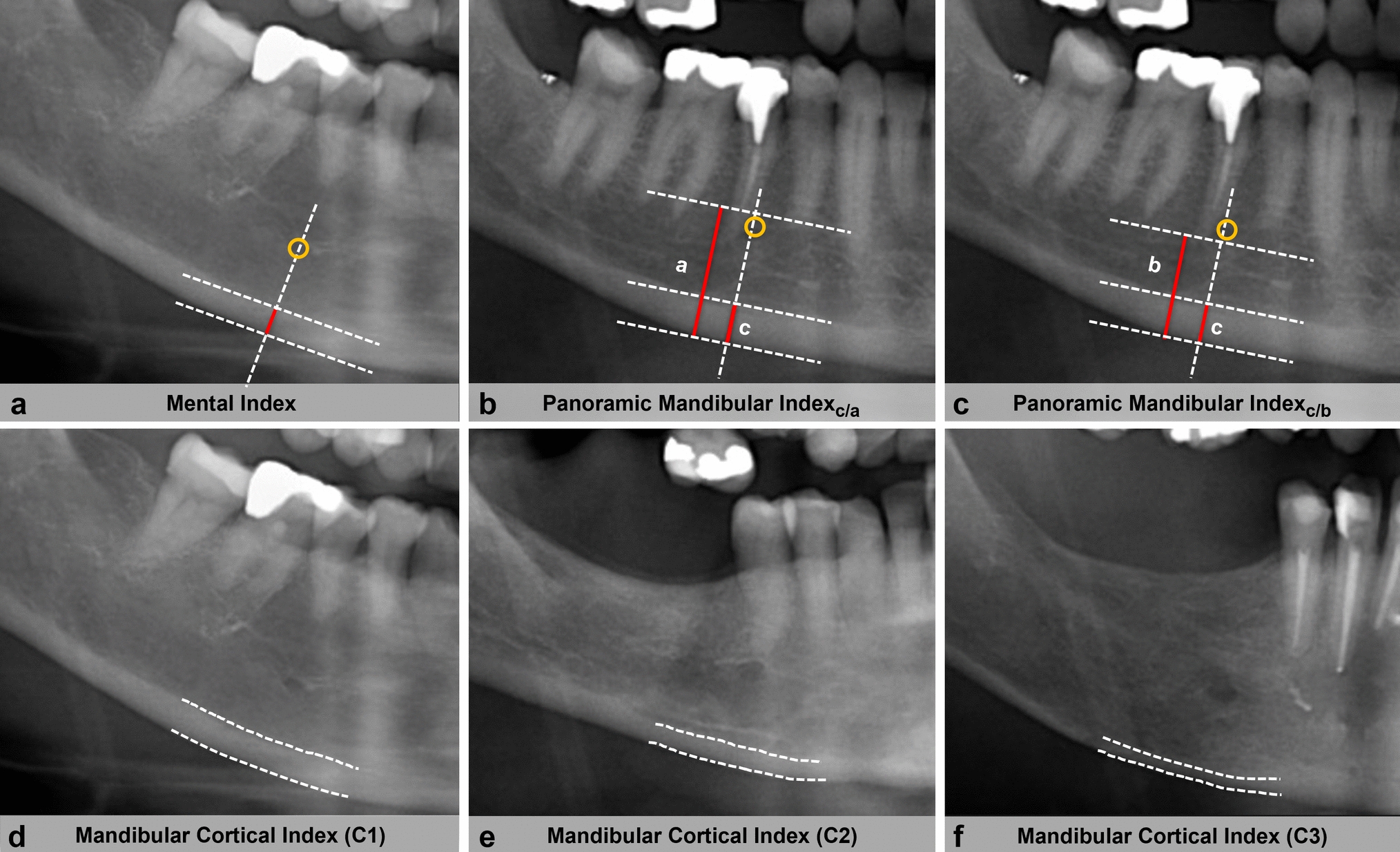 Radiomorphometric indices for measuring mandibular bone quality in oncologic patients