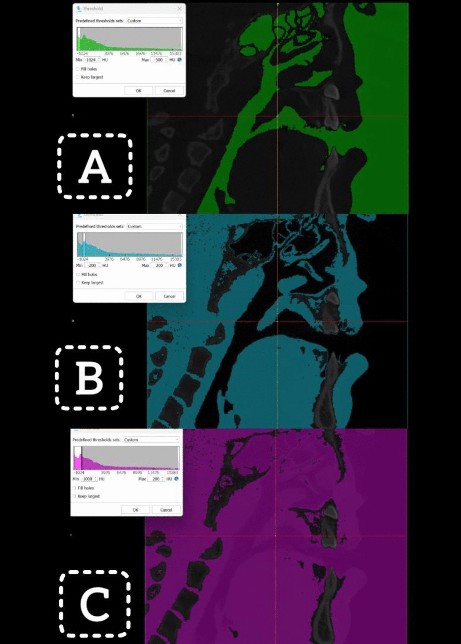 Assessment of the correlation between the volume of tongue, oral cavity, tongue/oral cavity volume ratio and the upper airway in unilateral cleft subjects: A CBCT study
