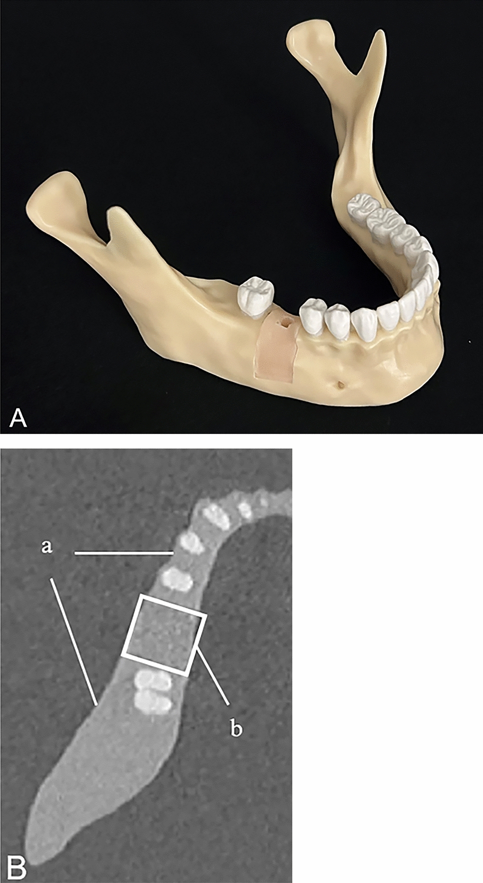 Challenges in detecting various peri-implant bone defects on modified intraoral oblique radiographic projections: evaluation of an artificial mandibular model