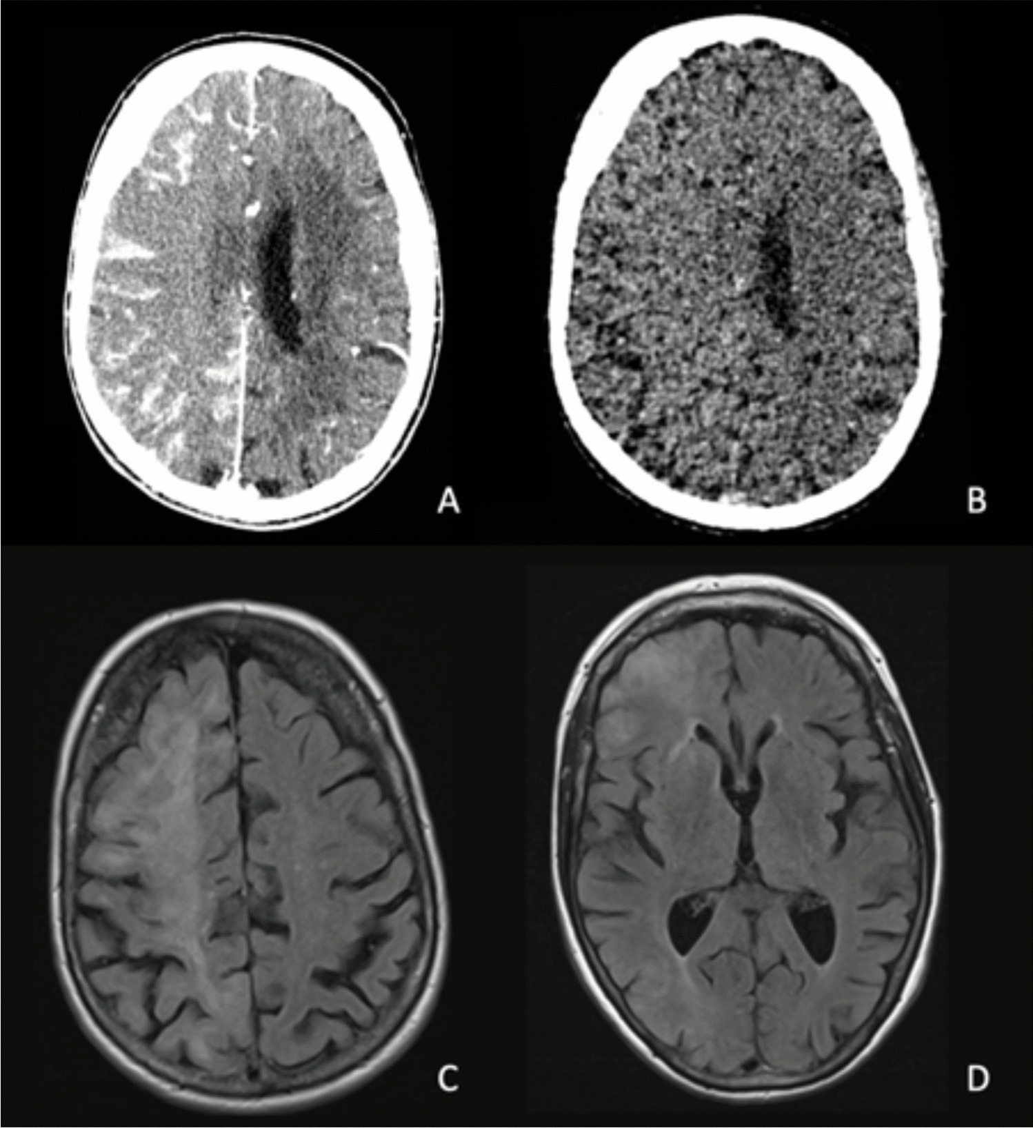 The Australian Diagnostic Criteria for Contrast-Induced Encephalopathy