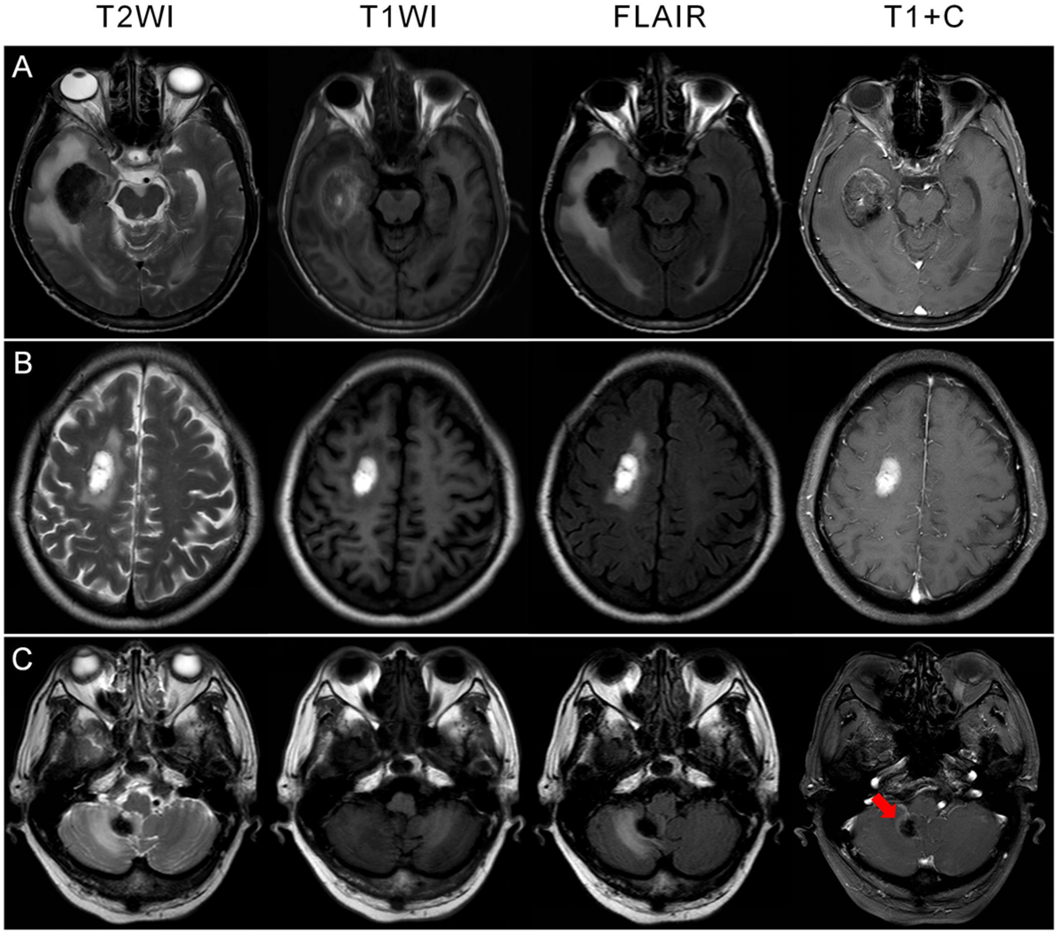 Improving differentiation of hemorrhagic brain metastases from non-neoplastic hematomas using radiomics and clinical feature fusion