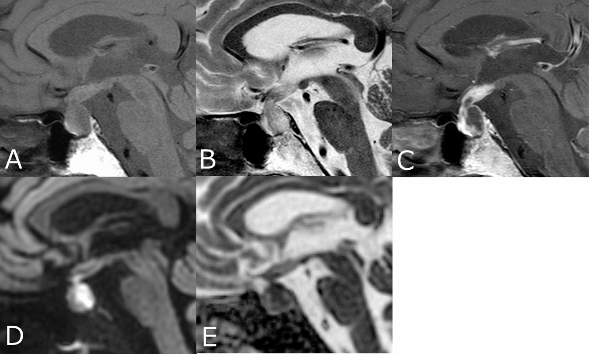 Usefulness of 3T split acquisition fast spin-echo diffusion-weighted imaging for differentiating pituitary abscess from other sellar cystic lesions: a preliminary study