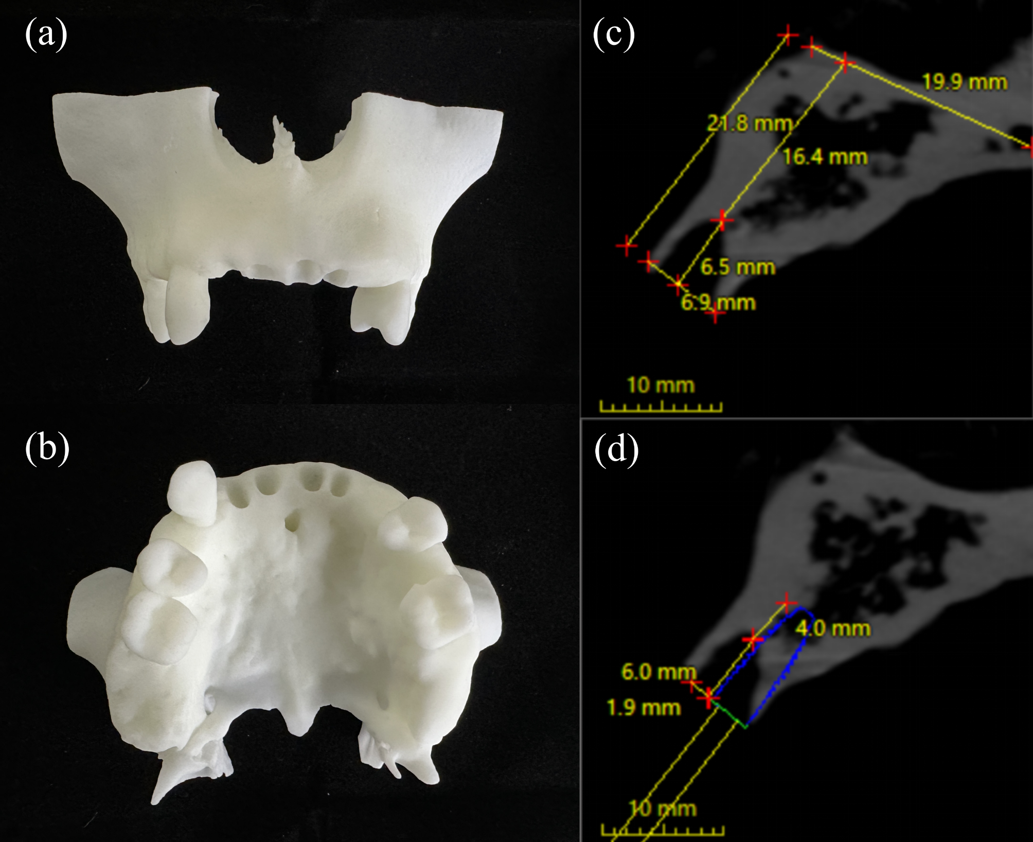 The accuracy of different macrogeometry of dental implant in dynamic navigation guided immediate implant placement in the maxillary aesthetic zone: an in vitro study