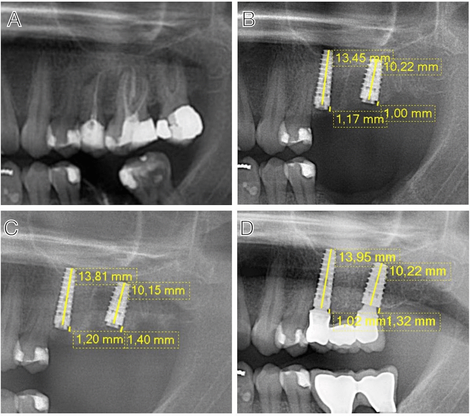 Marginal bone loss and associated factors in immediate dental implants: a retrospective clinical study