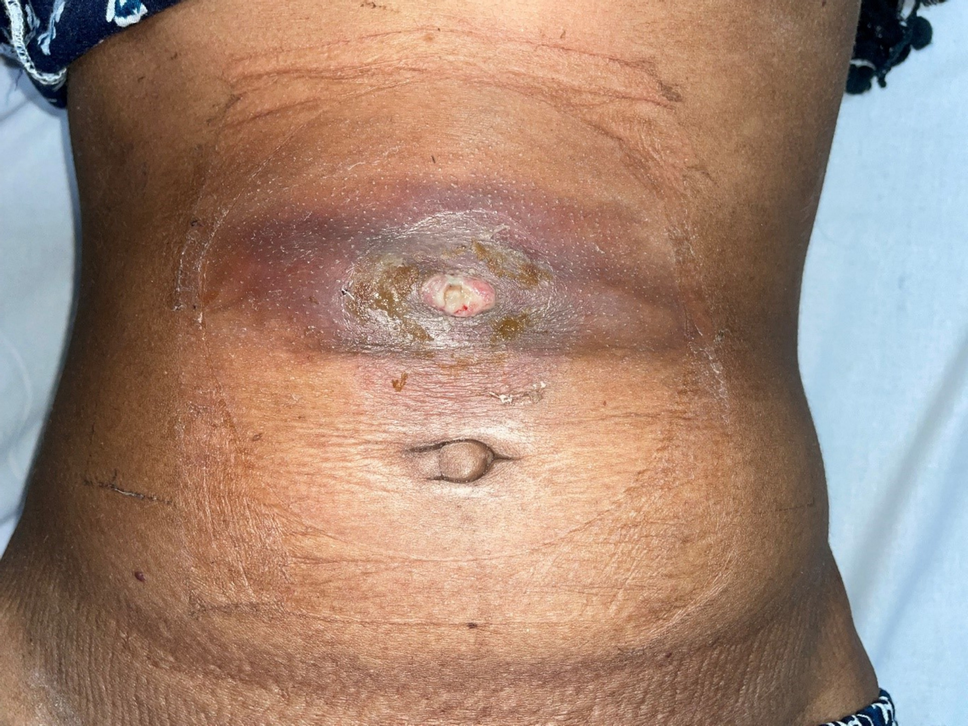 Locally Advanced Gallbladder Cancer (GBC) Presenting as Cholecysto-colo-cutaneous Fistula: A Rare Occurrence
