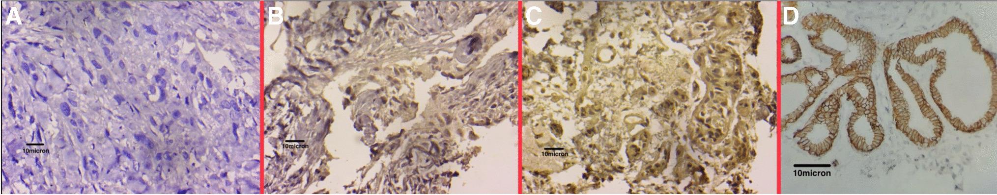 Prognostic Role of Androgen Receptor in Triple-Negative Breast Cancer: A North Indian Tertiary Care Study