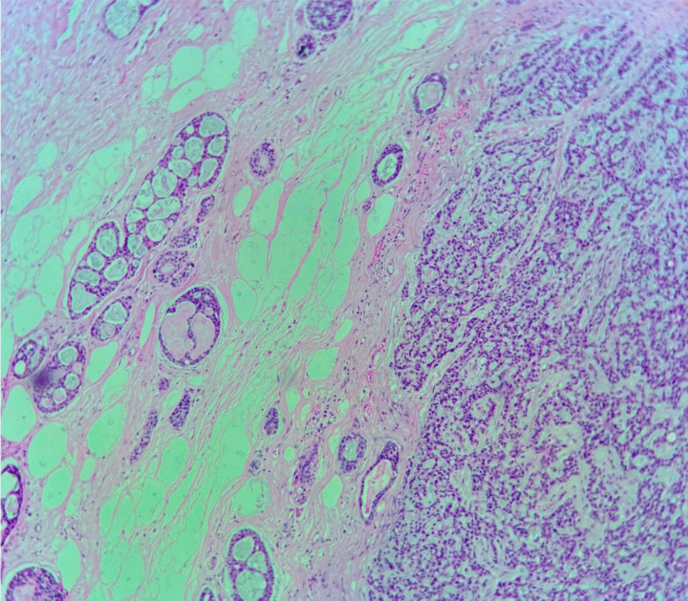 Adenoid Cystic Carcinoma of Breast—A Narrative Review