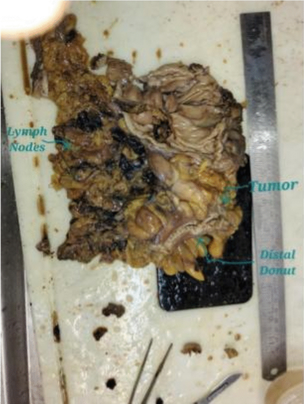 Development of Margin Compromise Ordinal Score (MCOS) Based on Analysis of Various Factors Associated with Margin Compromise in Patients of Carcinoma Rectum Undergoing Restorative Surgery